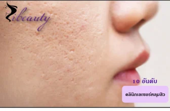 เลเซอร์หลุมสิว